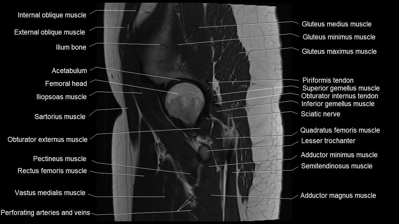 Hip sagittal cross sectional anatomy image 17.webp